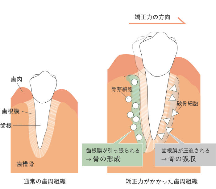 マウスピース型矯正もワイヤー型矯正と治療の原理は同じです