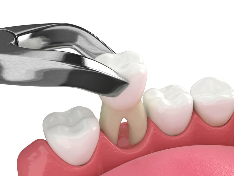 3. 矯正治療で抜歯を行わない場合のメリット