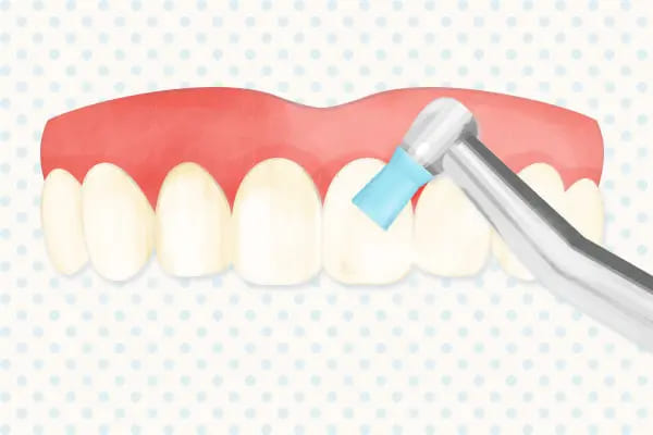 3. 歯面の清掃（PMTC）