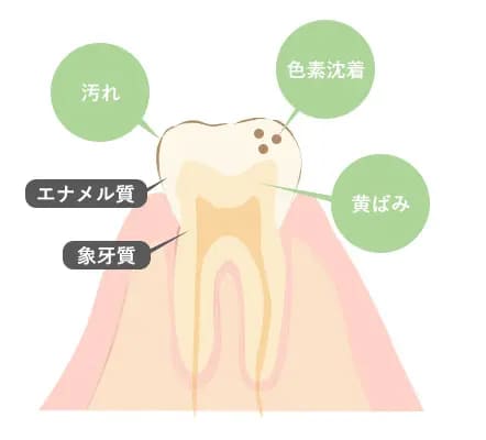 歯の黄ばむ原因は？