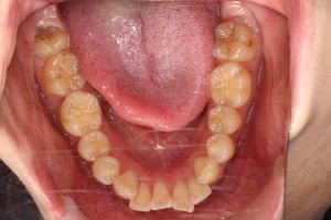 小さい歯槽骨からあふれ出る歯