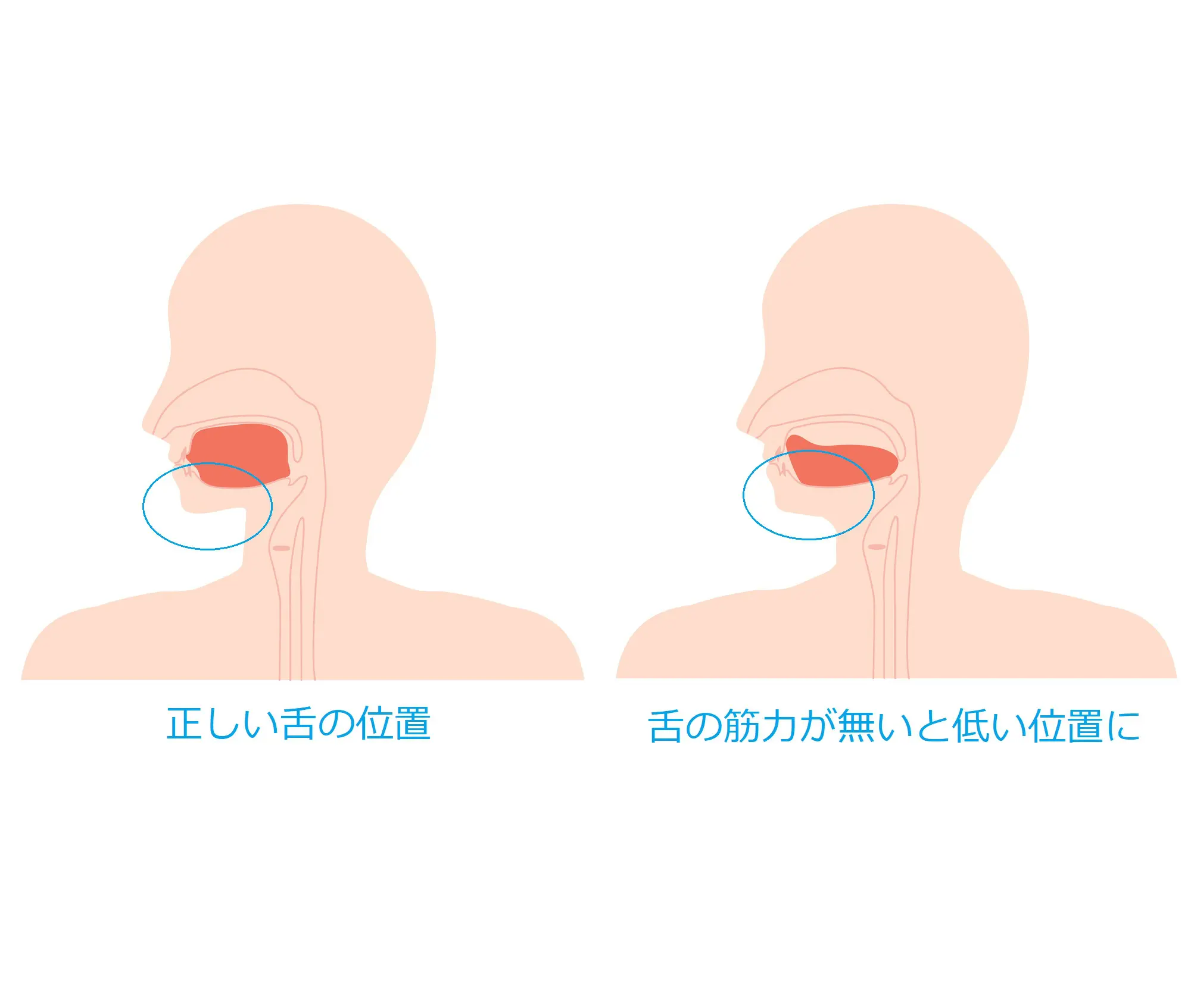 滑舌,矯正,低位舌