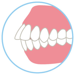 出っ歯　矯正　難波