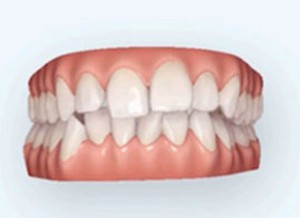 難波矯正歯科　歯並び