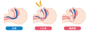 無呼吸症候群　寝ているとき　舌根