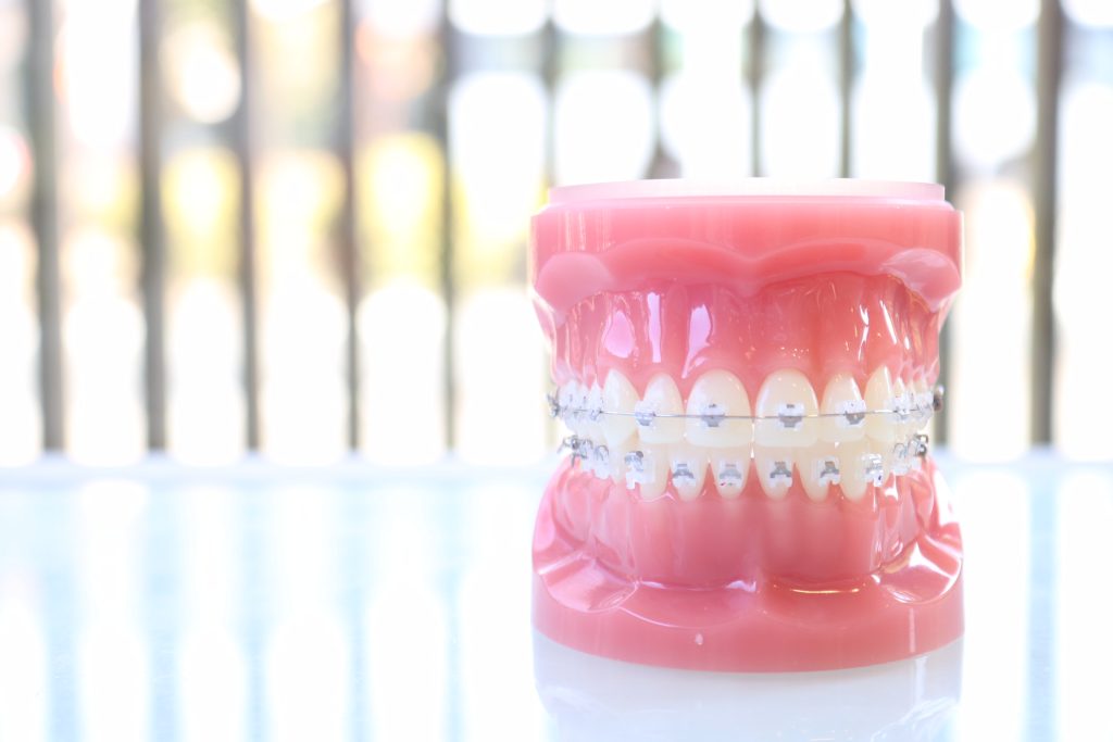 歯科矯正の装置の模型
