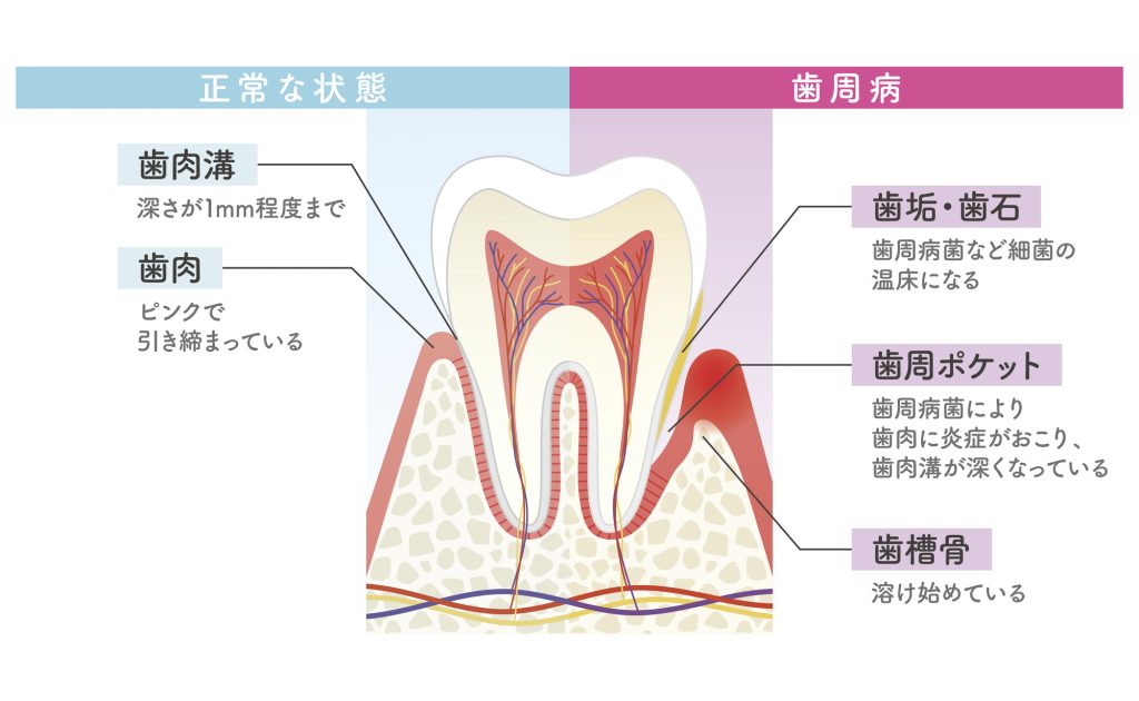 健康な歯と歯周病の歯の図解