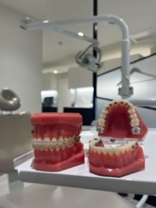 歯の模型,歯列矯正,ワイヤー矯正