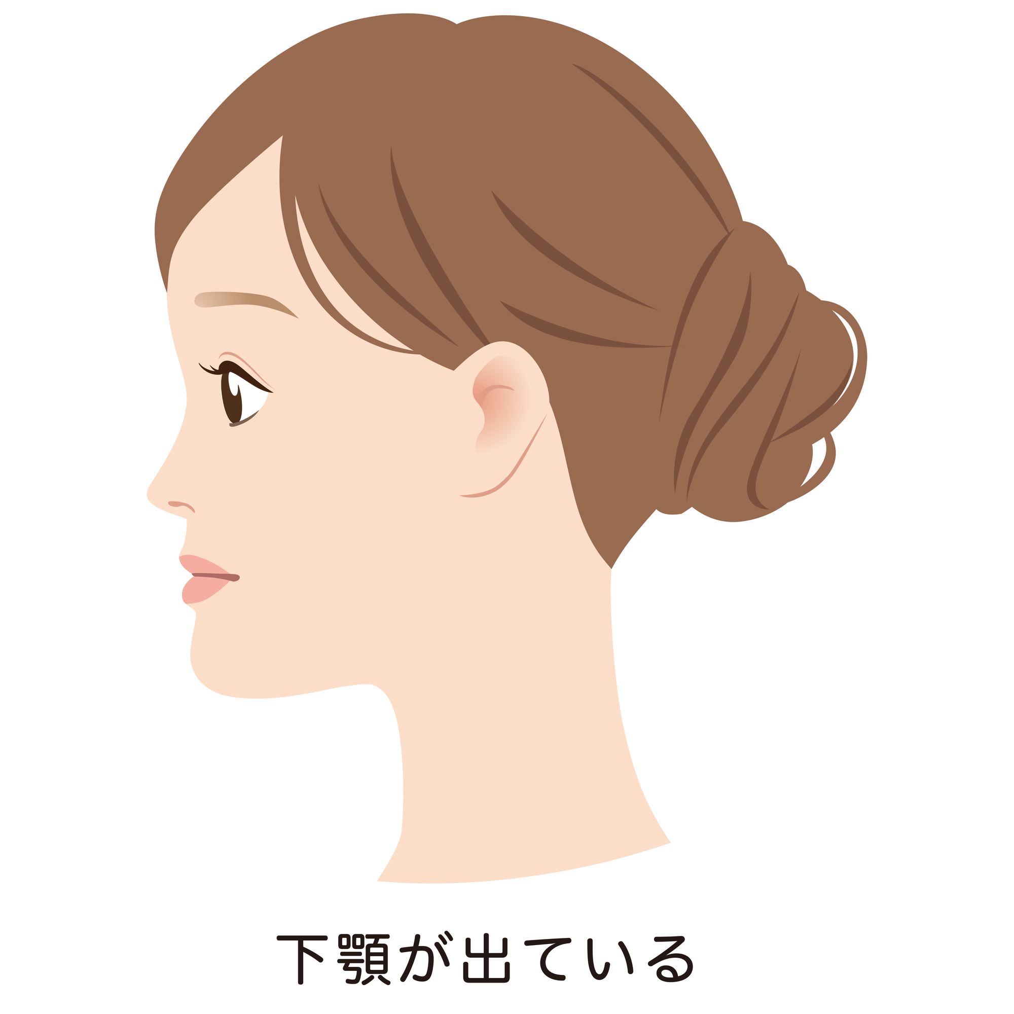 受け口　矯正　難波