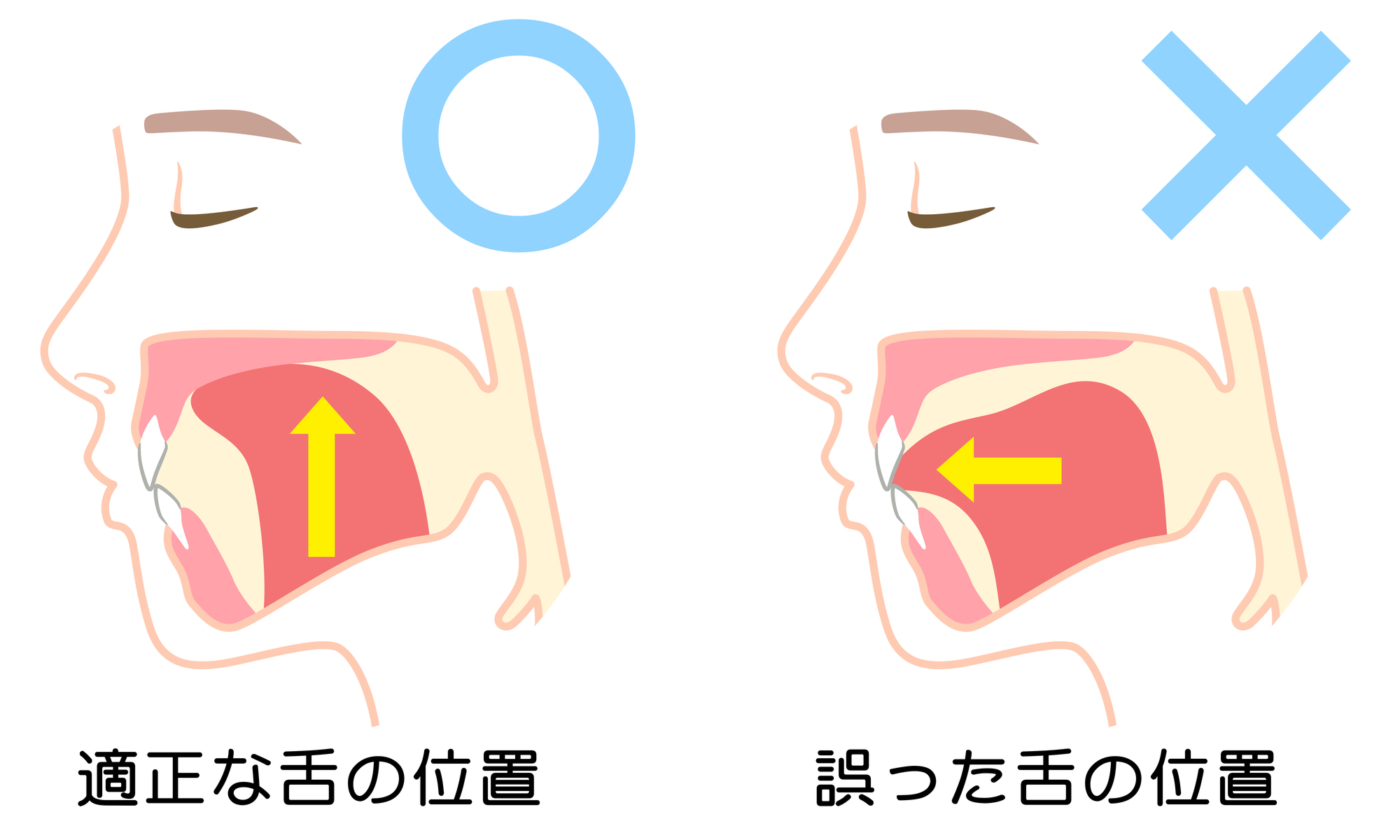 舌癖　トレーニング　難波