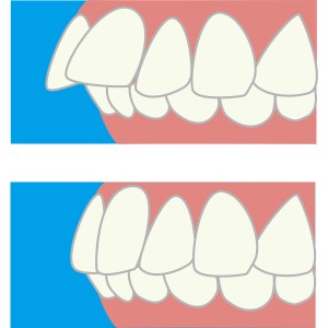 難波矯正歯科　歯科矯正　歯列矯正