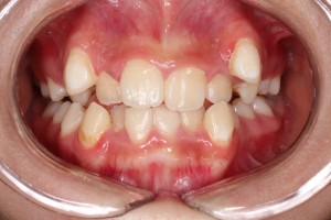 八重歯の主訴写真,難波矯正歯科