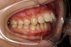 出っ歯の主訴写真,難波矯正歯科