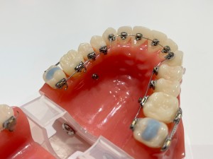 ワイヤー矯正,歯の模型,歯列矯正装置