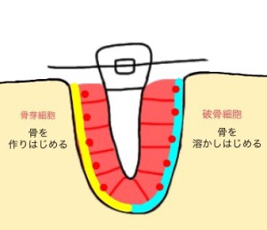 難波　歯列矯正　歯槽骨