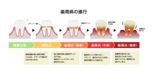 難波　矯正歯科　歯周病