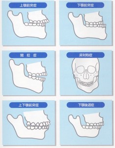 難波矯正歯科　大阪矯正　顎変形症