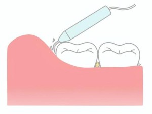 大阪矯正歯科　難波矯正歯科　スケーリング