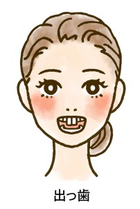 出っ歯の女性のイラスト