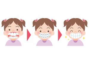 歯列矯正している女の子のイラスト