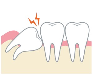 親知らずの不完全埋伏歯のイラスト