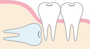 親知らずの完全埋伏歯のイラスト