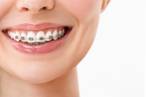 歯列矯正をしている女性の口元の画像