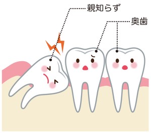 親知らずの図解イラスト