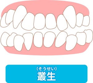 八重歯,叢生