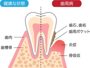 歯周病の図解