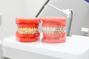 矯正治療の歯の模型