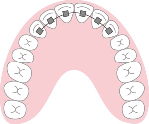 部分矯正,歯列矯正
