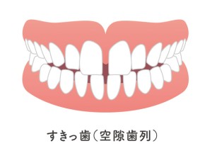 空隙歯列弓,すきっ歯のイラスト