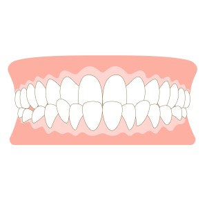 受け口,下顎前突の歯のイラスト