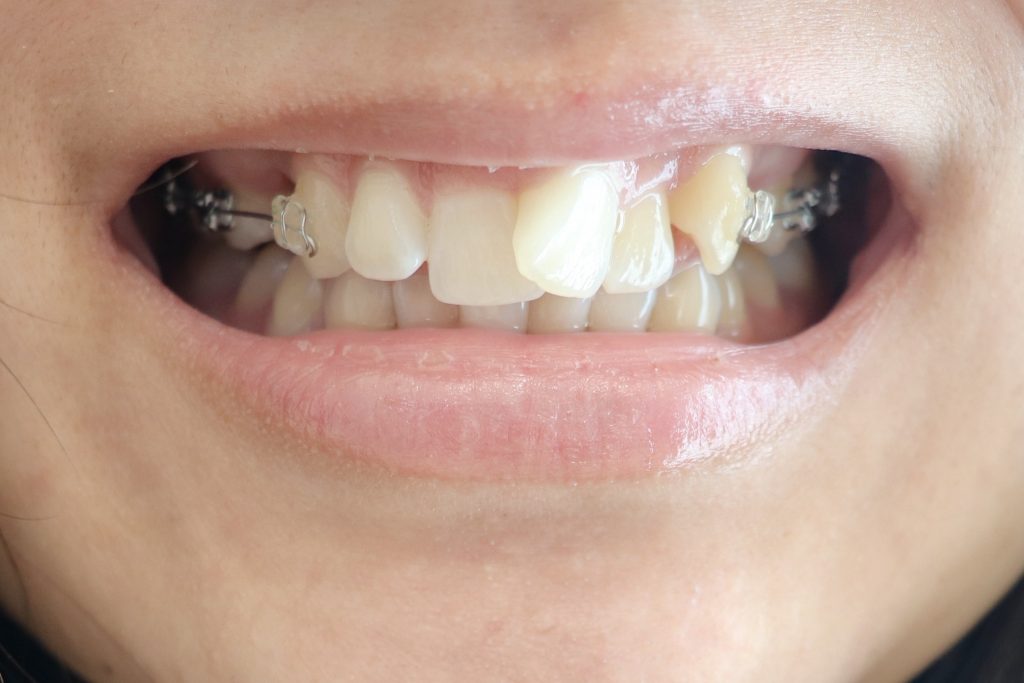 歯列矯正治療をしている歯