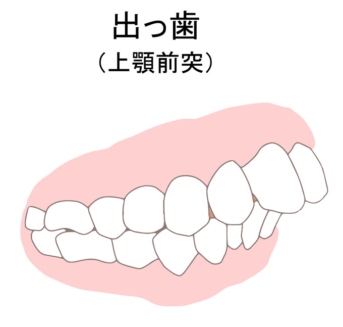 不正咬合の出っ歯（上顎前突）のイラスト
