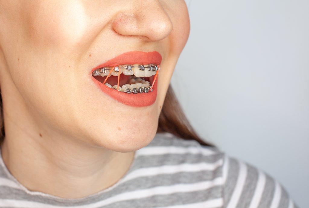 歯列矯正（表側のワイヤー矯正）をしている女性の口元の画像