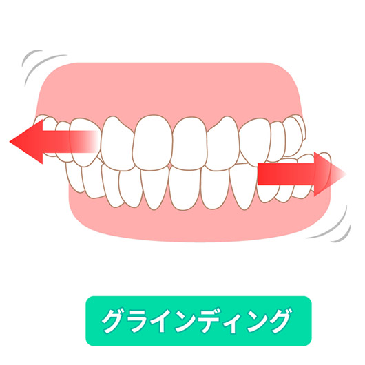 歯ぎしり（グライディング）のイラスト