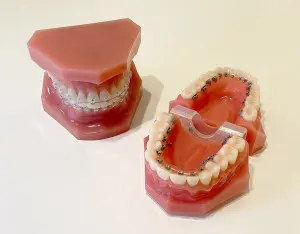 ワイヤー矯正の歯の模型
