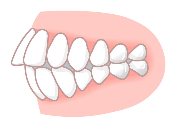 出っ歯（上顎前突）のイラスト