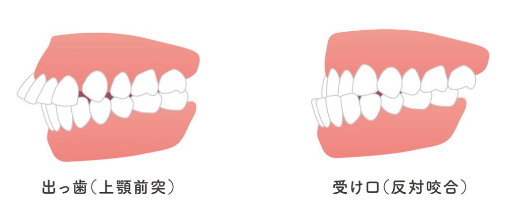 上顎前突と下顎前突のイラスト