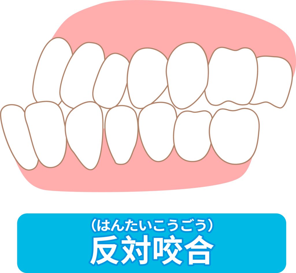 反対咬合（下顎前突）のイラスト