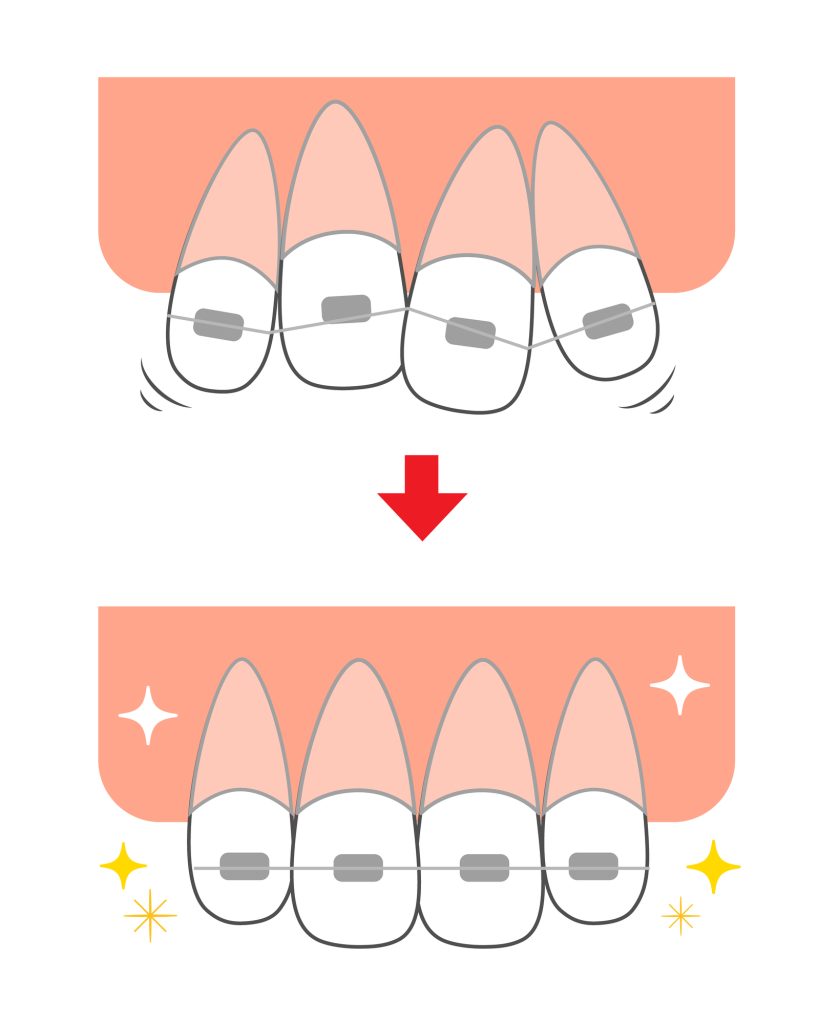 歯列矯正のビフォーアフターのイメージイラスト