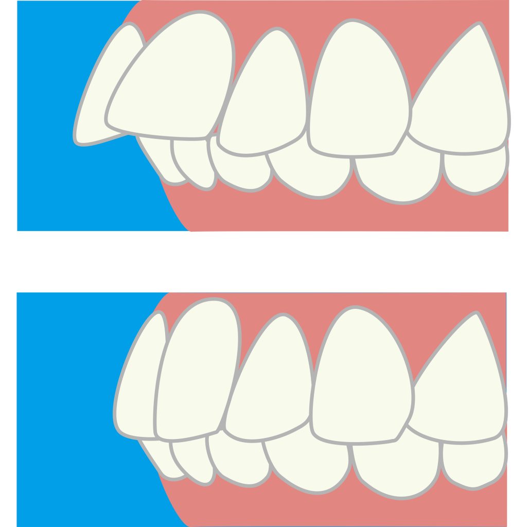出っ歯の治療前・治療後のイメージイラスト