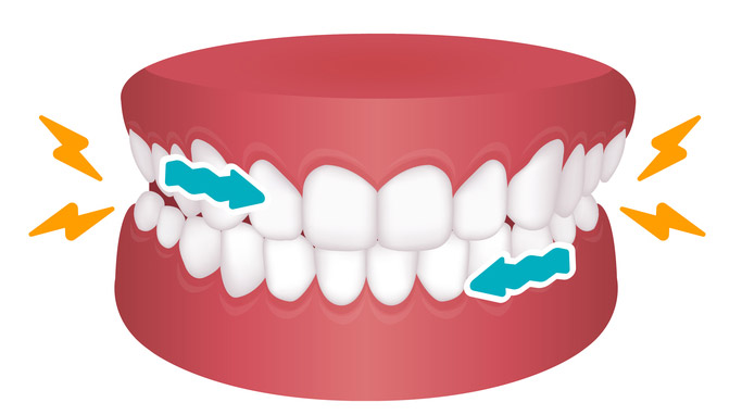 歯ぎしりのイラスト