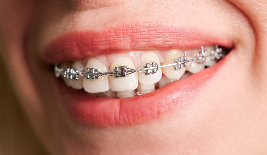 歯列矯正の装置をしている女性の口元