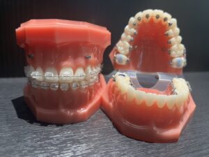 ワイヤー矯正　難波矯正歯科