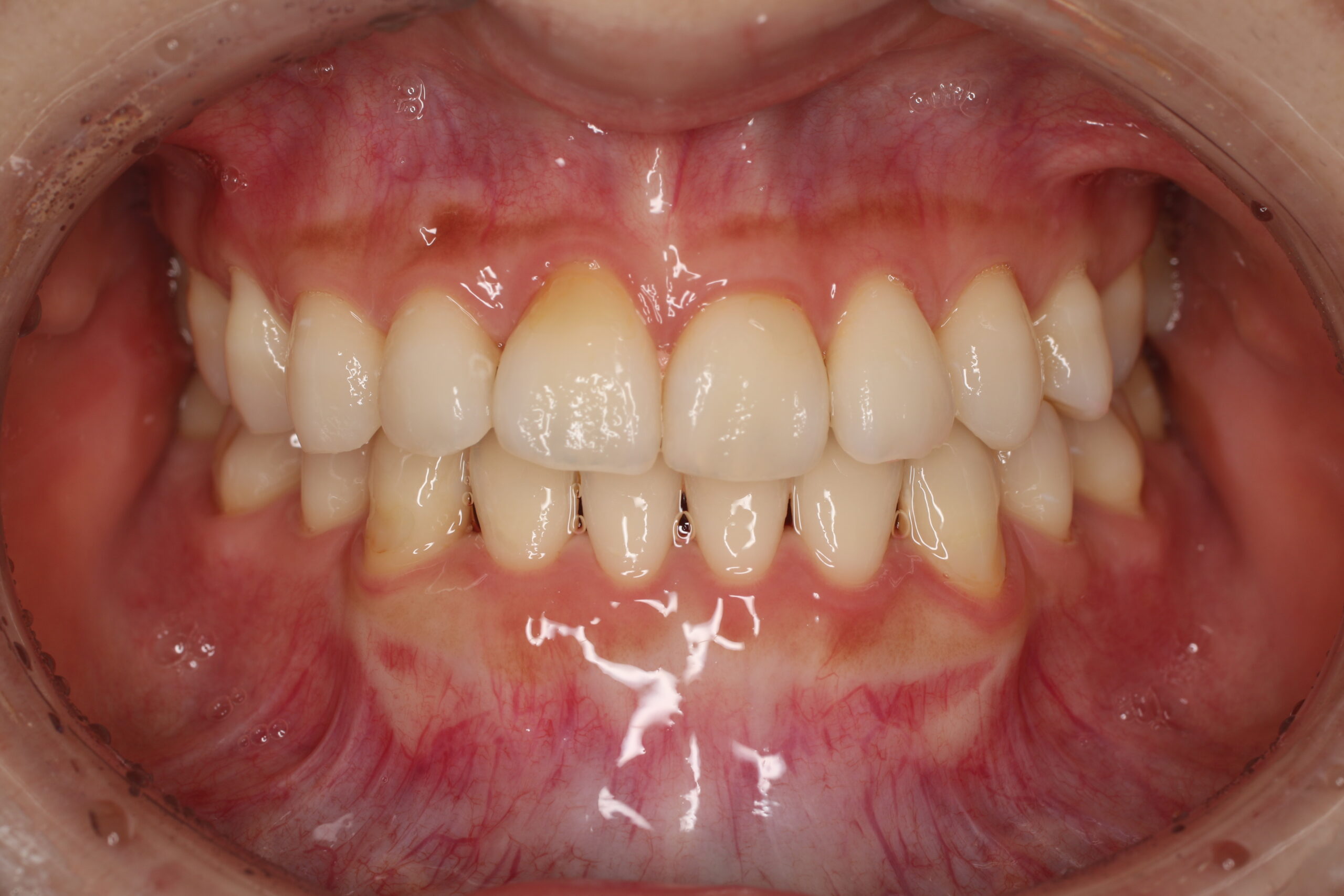 治療後　裏側矯正　難波