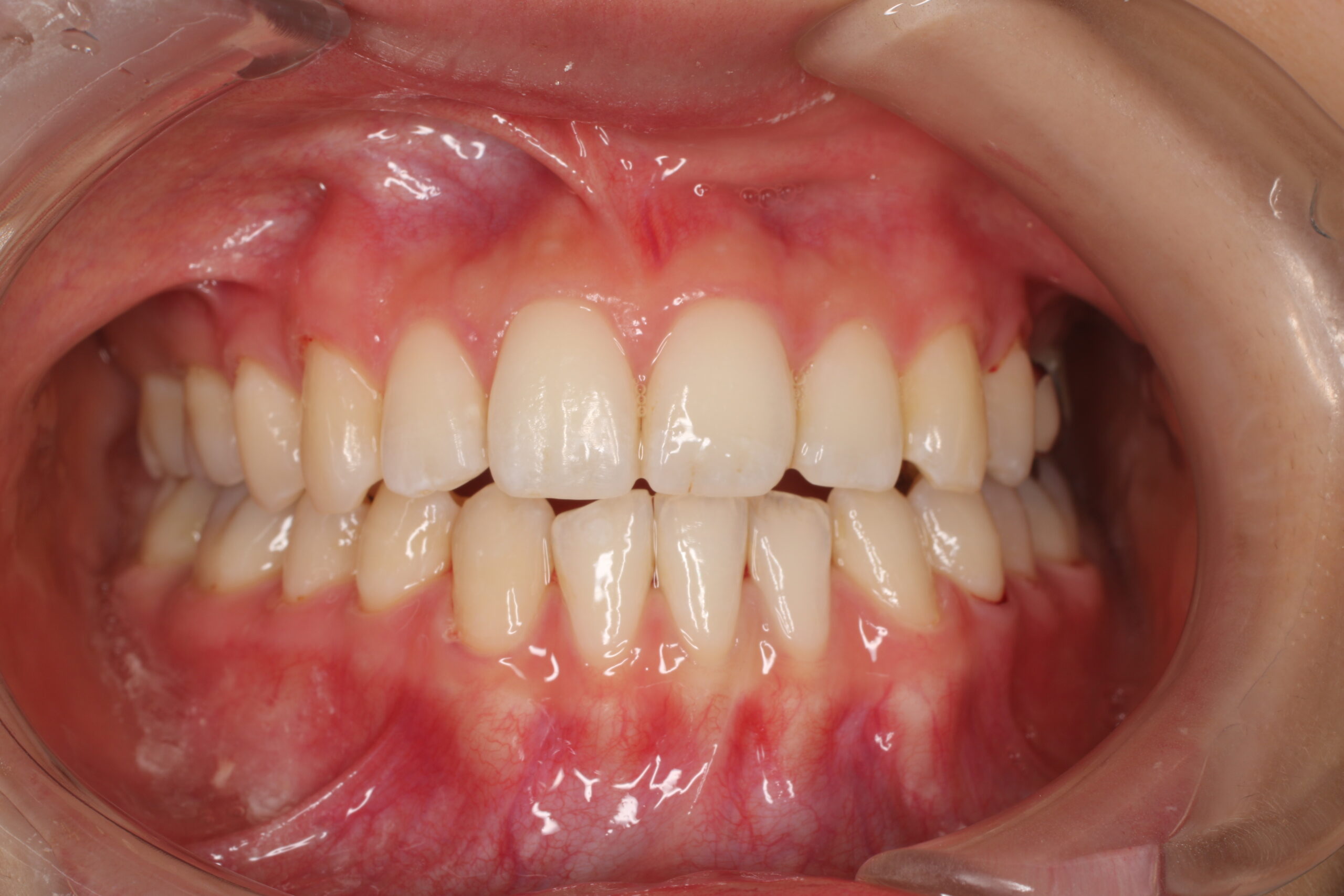 経過写真　矯正　難波