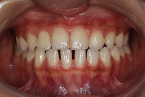 すきっぱ　部分矯正